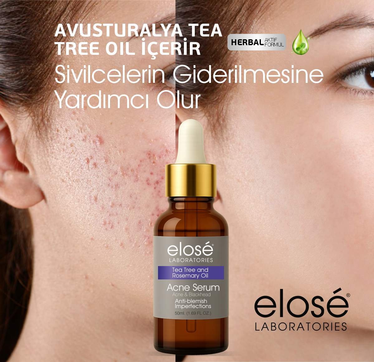 Sivilce Serumu (Çay Ağacı Özlü) 50 ml - Elose Bitkisel Bakım - Görsel 2